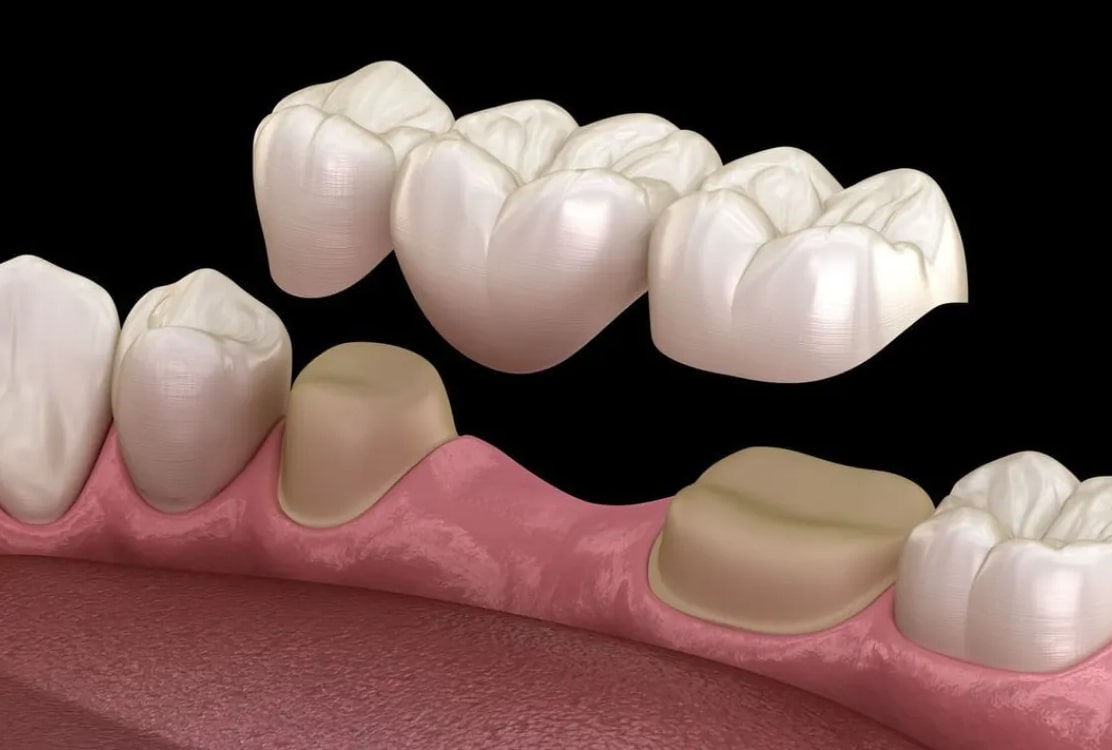 Illustration of a dental bridge above prepared teeth on either side of a missing tooth